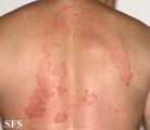 tinea corporis