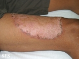 tinea corporis