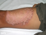 tinea corporis