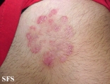 tinea corporis