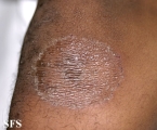 tinea corporis