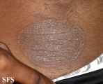 tinea corporis