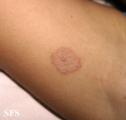 tinea corporis