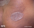tinea corporis