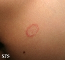 tinea corporis