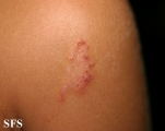 tinea corporis