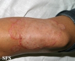 tinea corporis