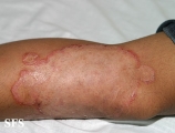 tinea corporis