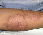tinea corporis