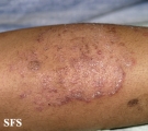tinea corporis