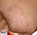 tinea corporis