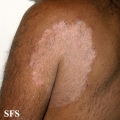 tinea corporis
