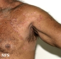 tinea corporis
