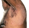 tinea corporis