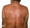 tinea corporis