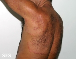 tinea corporis
