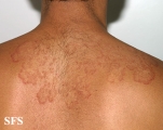 tinea corporis