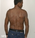tinea corporis