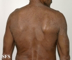 tinea corporis
