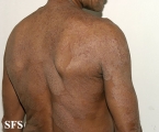 tinea corporis
