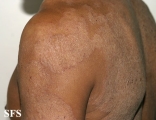tinea corporis