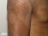 tinea corporis
