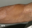 tinea corporis