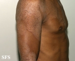 tinea corporis