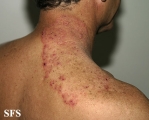 tinea corporis