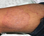 tinea corporis