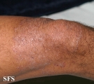 tinea corporis