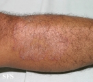 tinea corporis