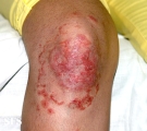 tinea corporis