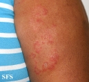 tinea corporis