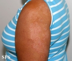 tinea corporis