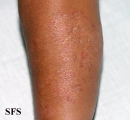 tinea corporis
