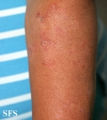 tinea corporis