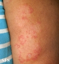 tinea corporis