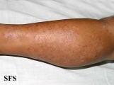 tinea corporis