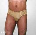 tinea corporis