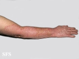 tinea corporis