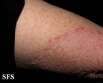 tinea corporis