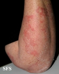 tinea corporis