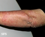 tinea corporis