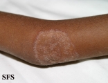 tinea corporis