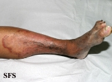 tinea corporis