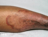 tinea corporis