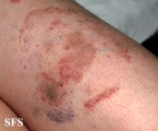 tinea corporis