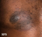 tinea corporis