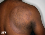 tinea corporis